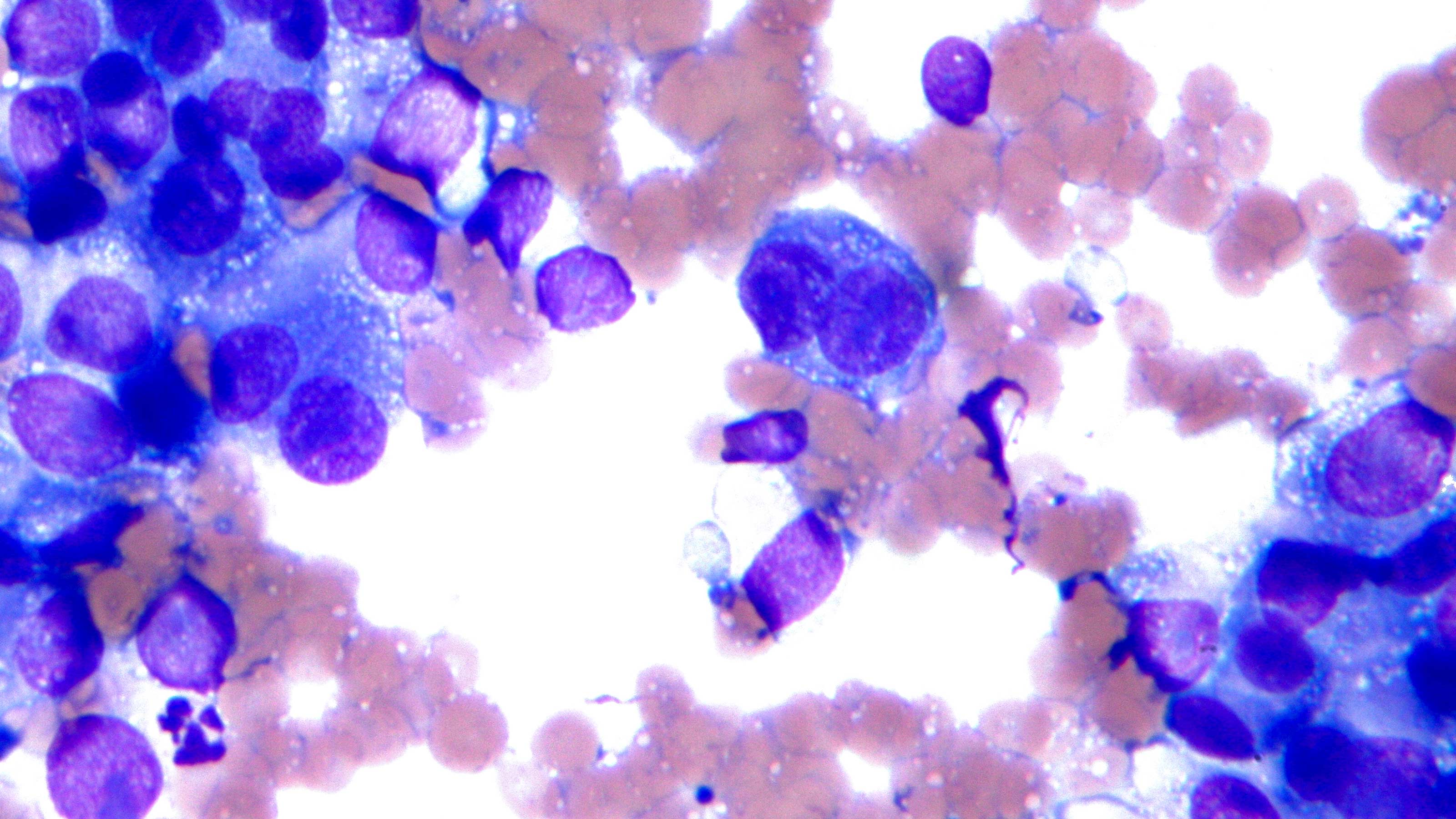 Personalized Skin Cancer Vaccine