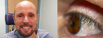 3D-printed prosthetic eye