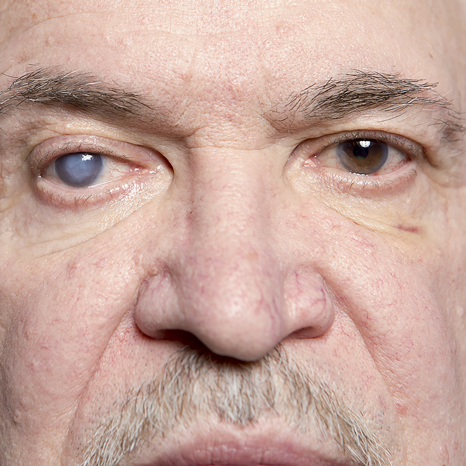 cataract surgery