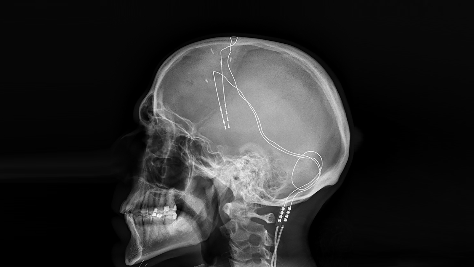 deep brain stimulator