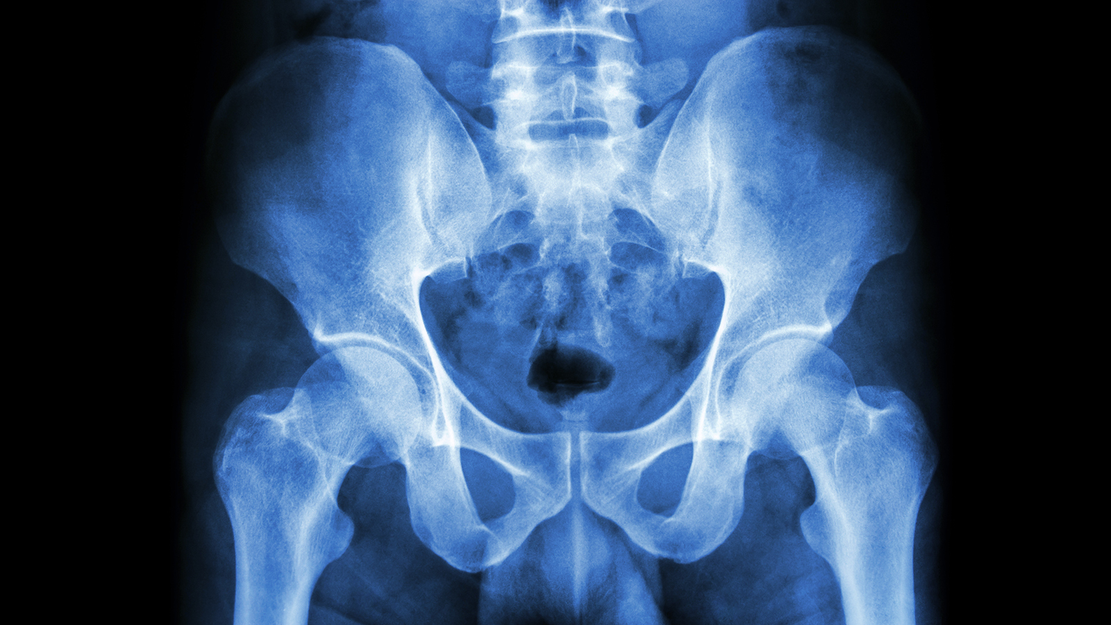 an x-ray of a human pelvis