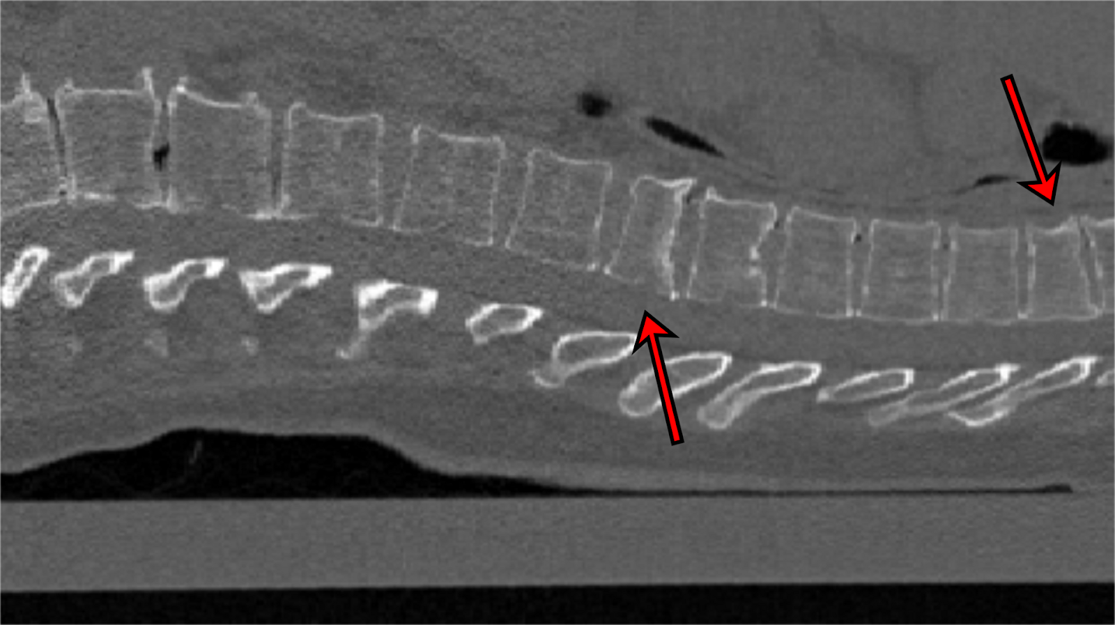 an x-ray of a spine