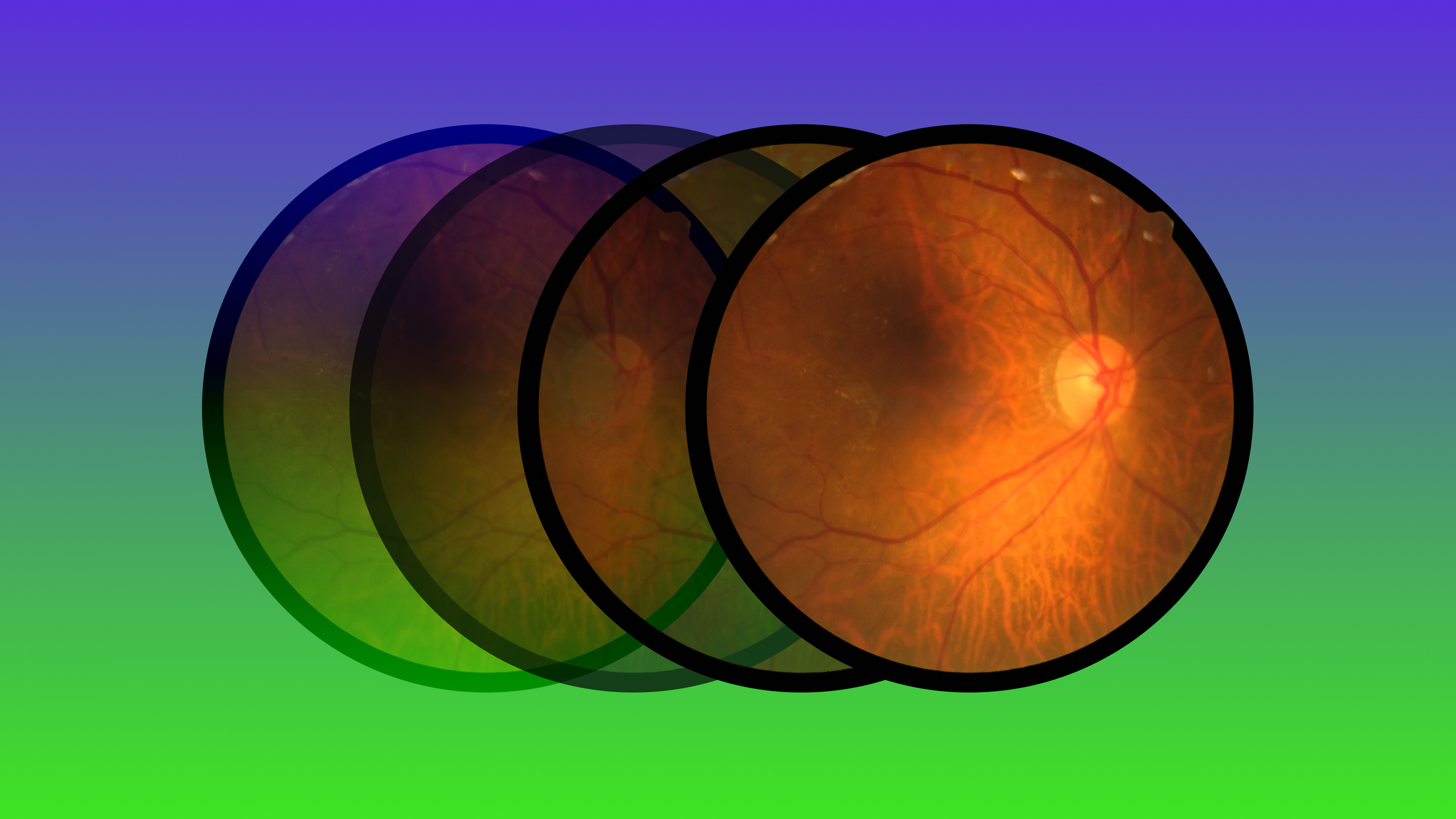 a microscopic image of a retina. It looks like an orange circle, with red blood vessels