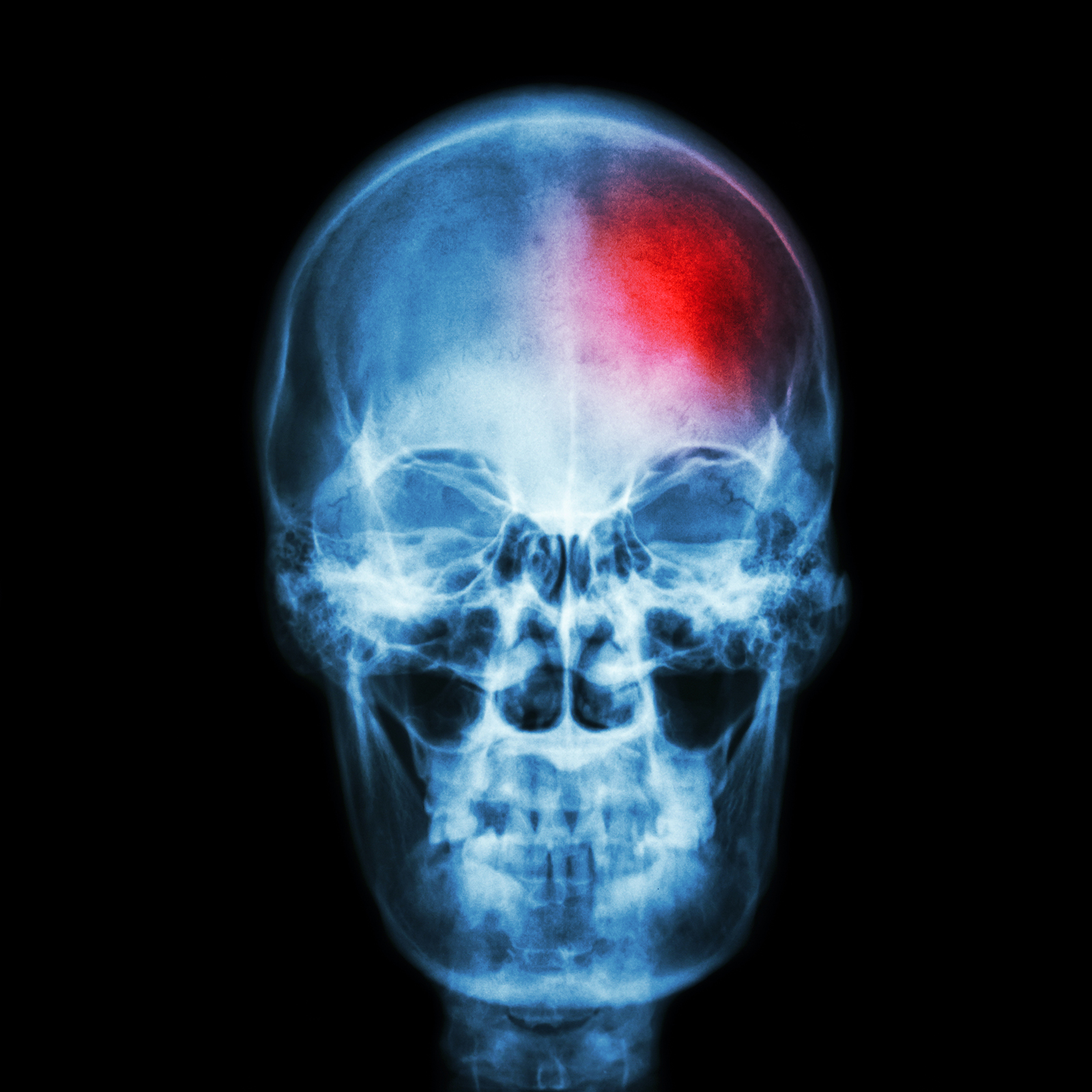 an x-ray of a human skull with part of the brain highlighted red